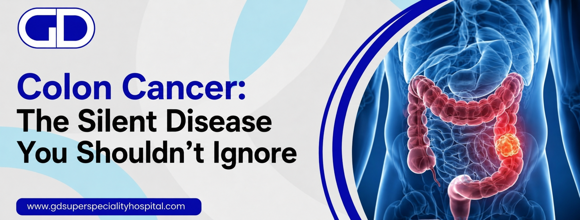 Colon Cancer: The Silent Disease You Shouldn’t Ignore